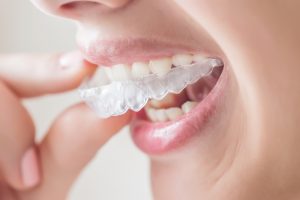 grinding-teeth-putting-mouthguard-nightguard
