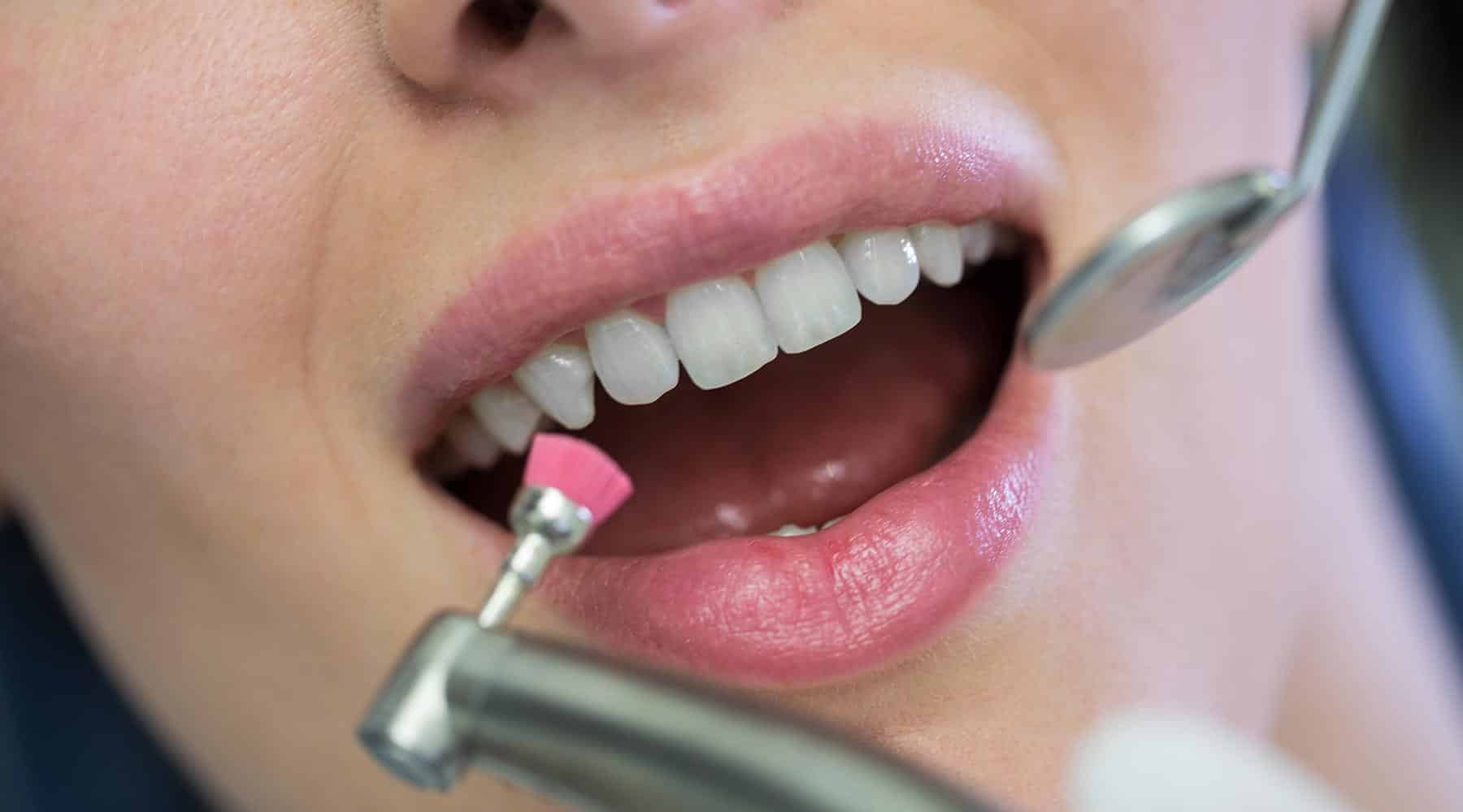 Dental Hygiene (Scale and Polish): How Often Should You Have It Done?