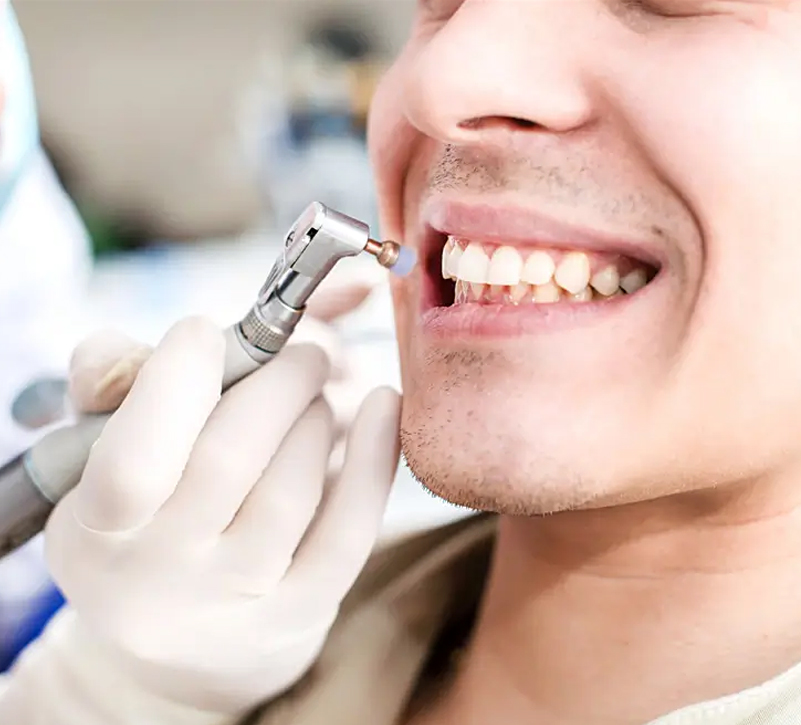 Dental hygiene appointment before teeth whitening